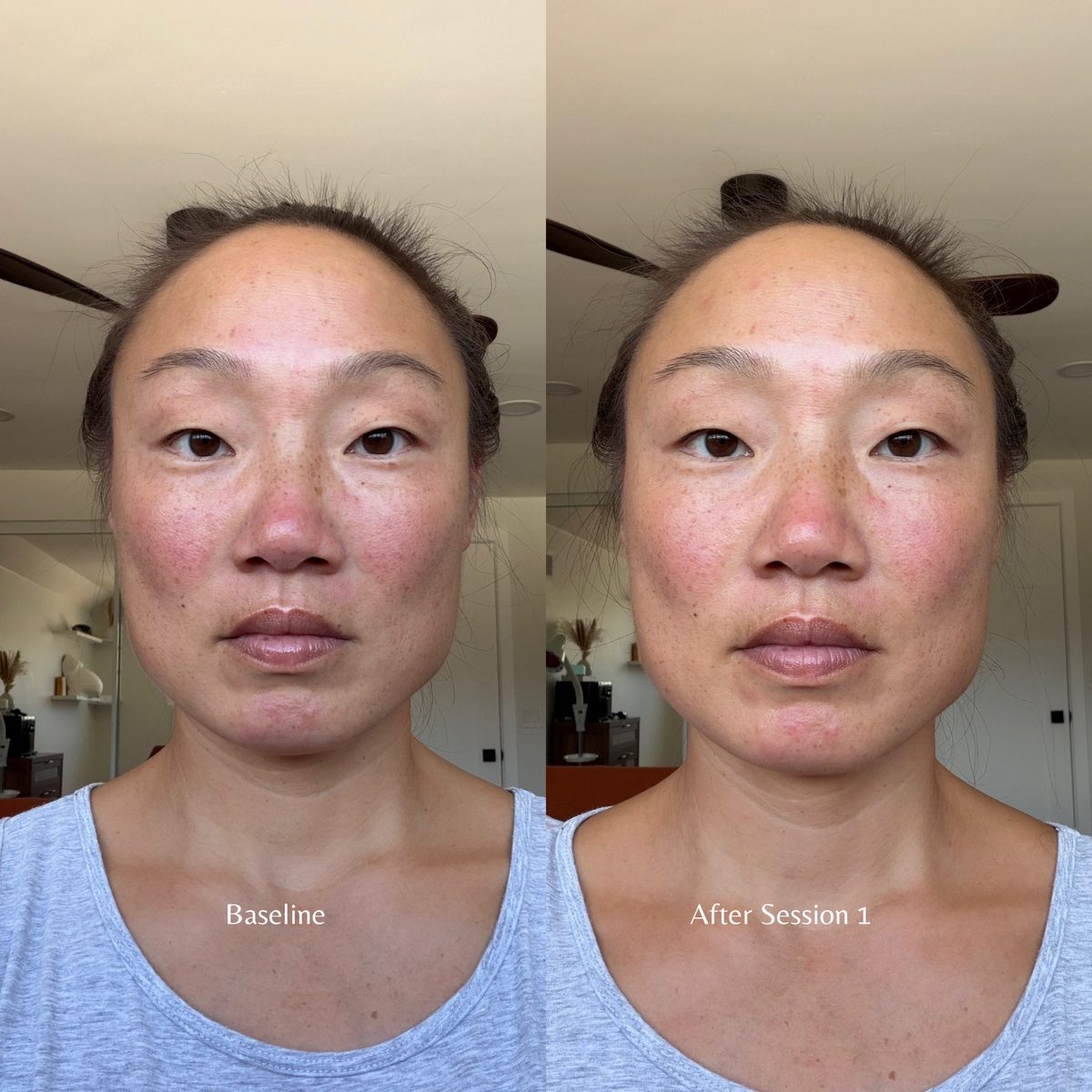 Side-by-side photos of Nina Jung, L.Ac., at baseline and after her first cosmetic acupuncture session. In the after photo, facial redness has settled and her eyes look more open.