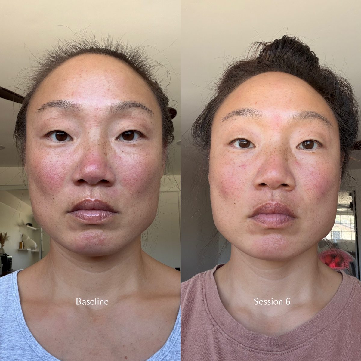 Side-by-side photos of Nina Jung, L.Ac., at baseline and after six cosmetic acupuncture sessions. The session 6 photo shows brighter, more even skin tone and less redness.