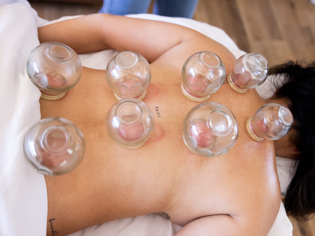 Cupping therapy applied along a patient's back during a treatment session.